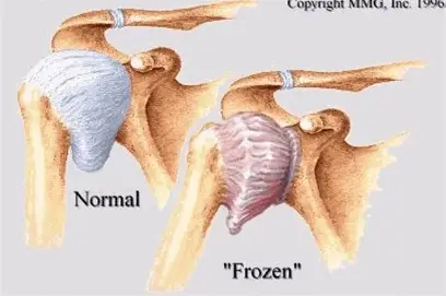 Frozen Shoulder